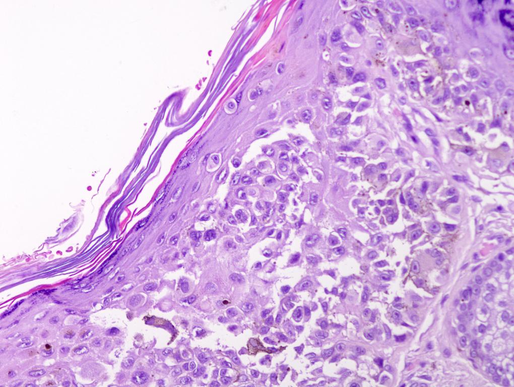 Pathology Outlines Invasive melanoma